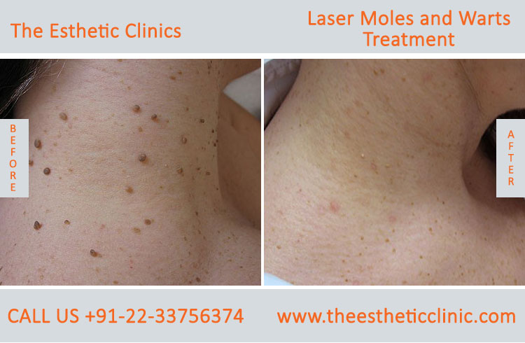 Moles Wart Skin Tags Laser Treatment before after photos in mumbai india (5)